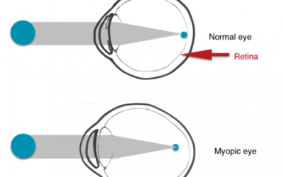 Cosa sappiamo della progressione miopica